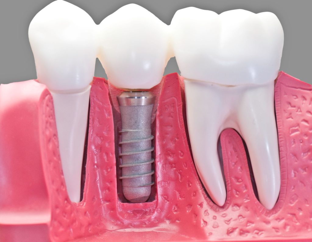 model of how dental implants work