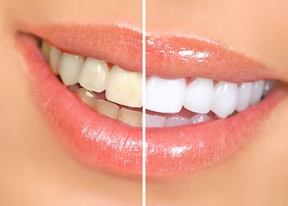 before and after photo of teeth whitening